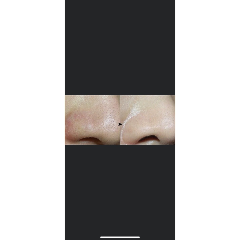 Huyết Thanh giải quyết vấn đề mụn cám, không bong tróc - 10ml
