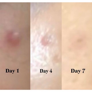 Kem Chấm Mụn Dạng Gel SVR Sebiaclear Cicapeel