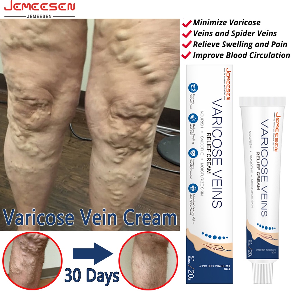 Jemeesen Vein Removal Paste Loại bỏ tĩnh mạch Sửa chữa Paste Loại bỏ tĩnh mạch sưng nhện tĩnh mạch 20g