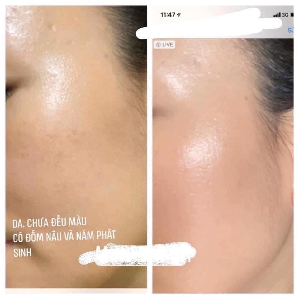 Mesoestetic Melan Tran3x Concentrate 30ml,Serum giảm nám chuyên sâu