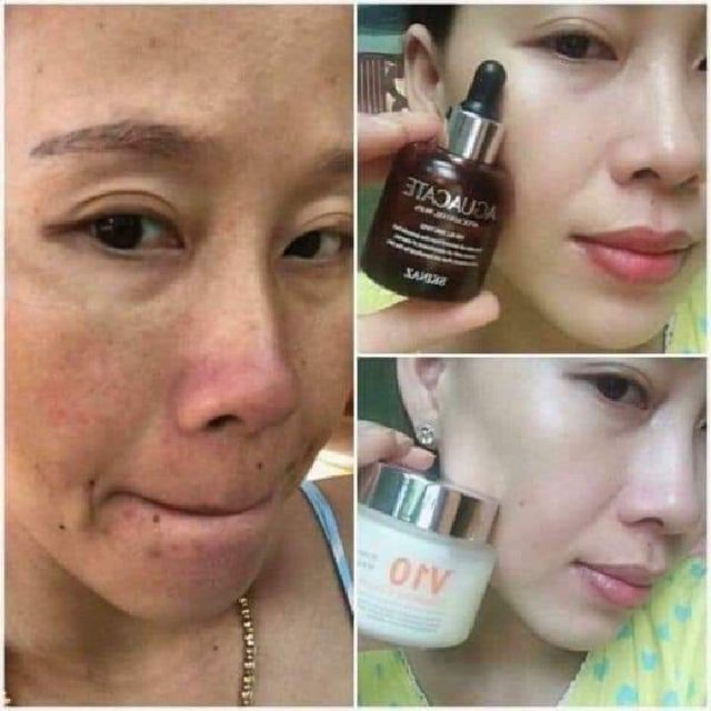 Kem V10 Skinaz  Kem dưỡng trắng da hiệu quả