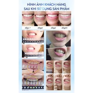 Miếng Dán hỗ trợ Trắng Răng ANRIEA - trắng sau 30p