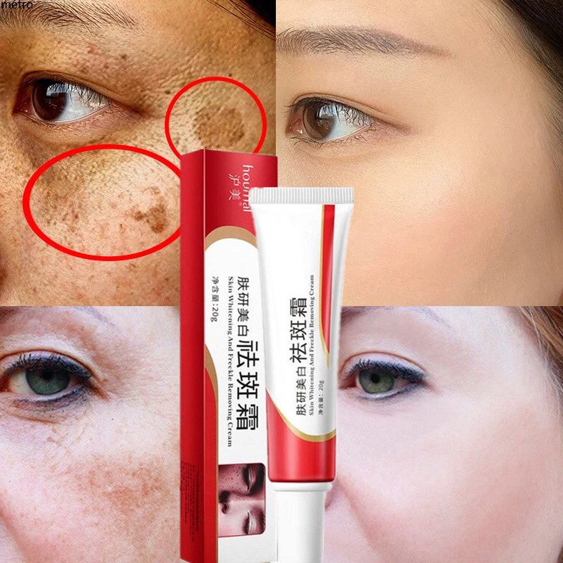 Kem Trị Nám Kem Tẩy Pekas Collagen Chính Hãng Nhật Bản Kem Tẩy Pekas Chính Hãng & Tàn Nhang Metro