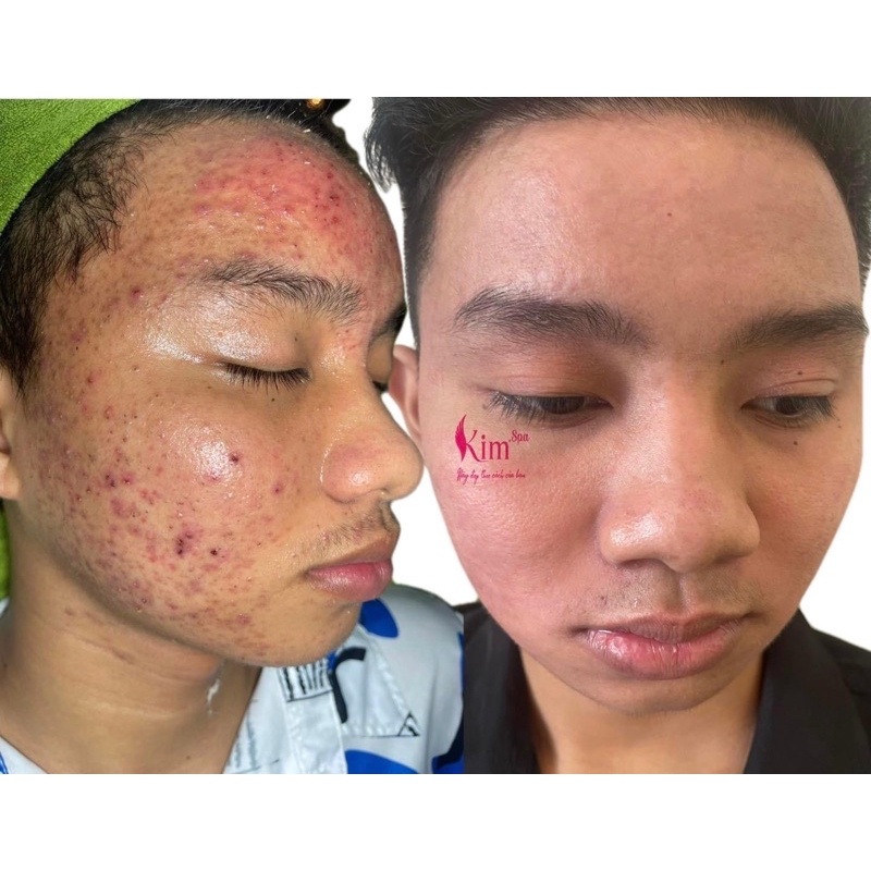 Kem Tái Tạo Mụn Đông Y Dành Cho Nam Không Bong Trắng Không Sưng Đỏ Mặt Tự Nhiên