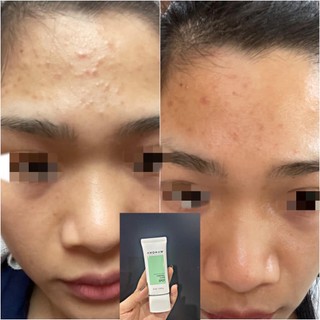 Tinh Chất Chấm Mụn Ahohaw Acless Solution 30ml ( Chính Hãng )