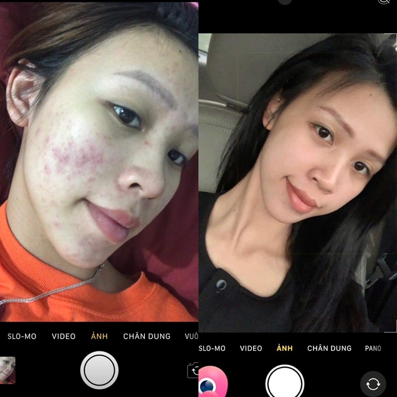 Serum sạch mụn giảm thâm neslyn ampoule,Serum gom khô nhân mụn