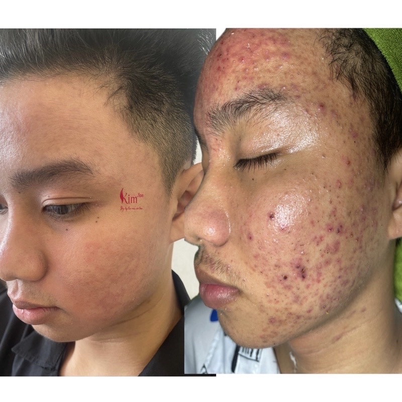 Kem Sâm Tái Tạo Đông Y Chuyên Cho Nam Không Bong Trắng Không Sưng Đỏ Mặt Tự Nhiên