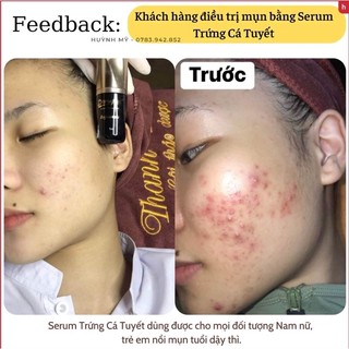 Combo trị mụn chuyên sâu