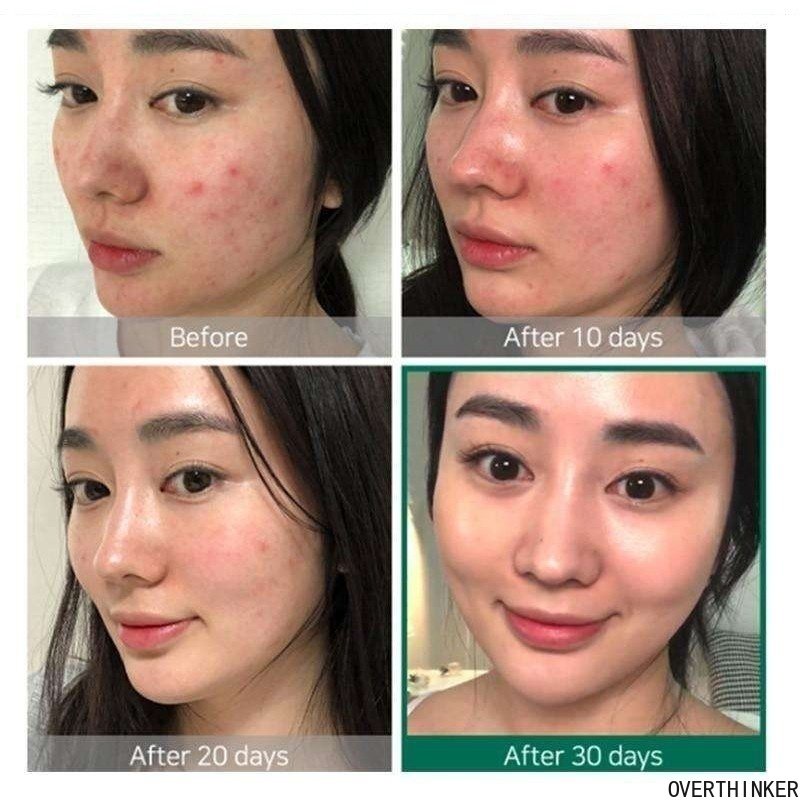 THE ORDINARY Hàng Có Sẵn Axit Salicylic 30% AH-A + B-HA 2% Chính Hãng Tinh Chất Tẩy Tế Bào Chết Toàn Thân 30ML