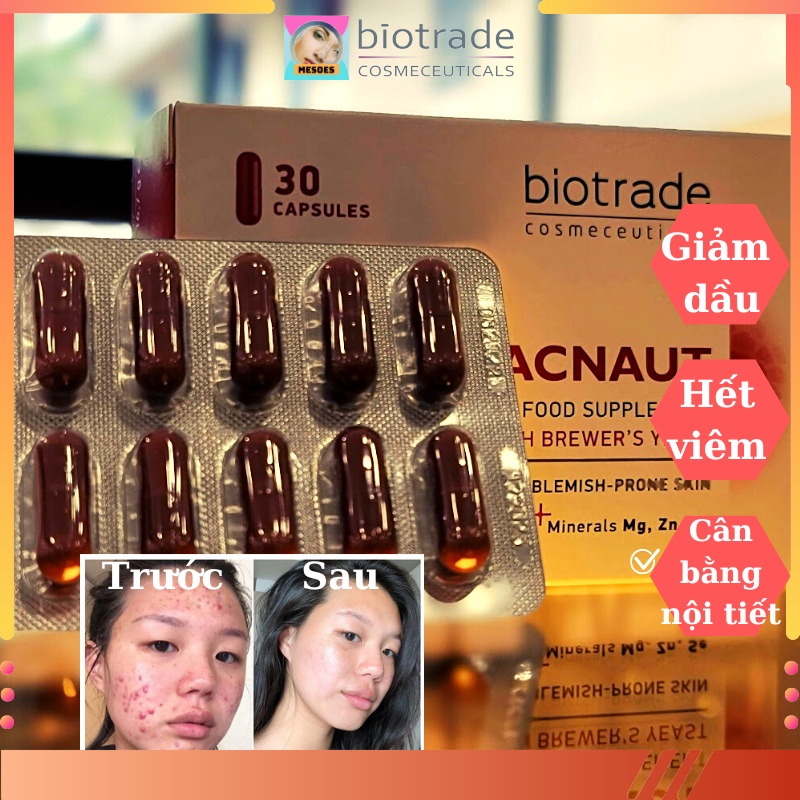 Viên Uống Giảm Mụn Biotrade Acnaut Food Supplement 30 Viên Giúp Kiềm