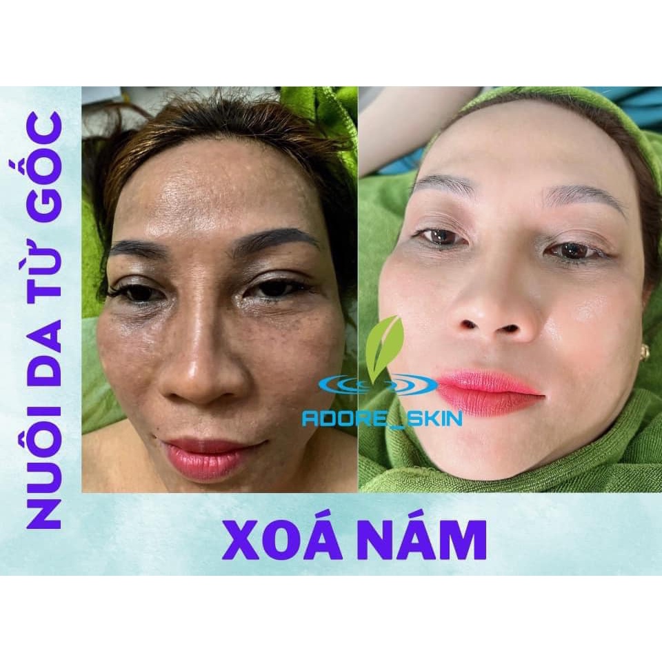 Bộ 3 sản phẩm loại bỏ nám không bong ADORE SKIN MELASMA