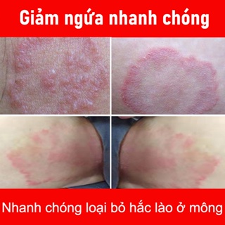 Kháng khuẩn vùng kín kem giảm ngứa kem chống chàm eczema giảm ngứa thảo - ảnh sản phẩm 2