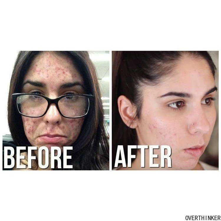 THE ORDINARY Hàng Có Sẵn Axit Salicylic 30% AH-A + B-HA 2% Chính Hãng Tinh Chất Tẩy Tế Bào Chết Toàn Thân 30ML