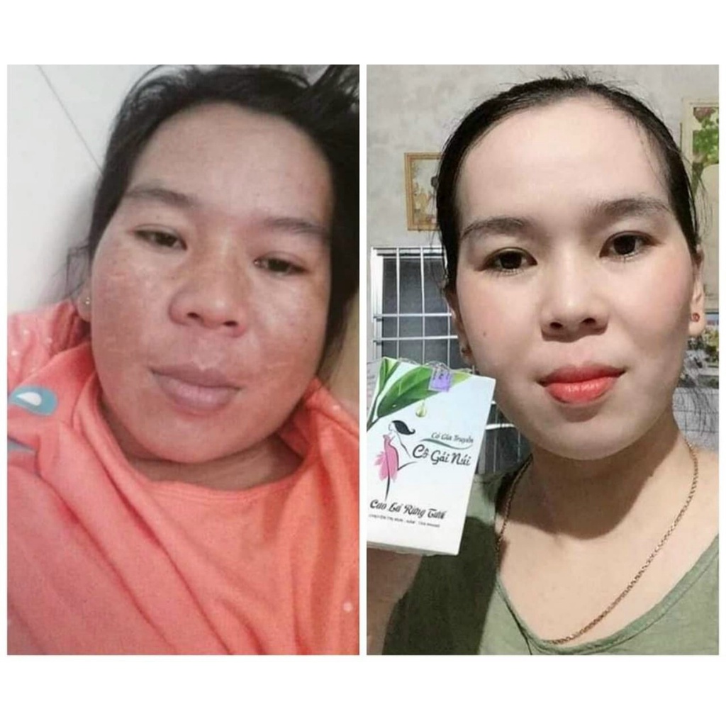Chính hãng - Kem FACE SỮA 5in1 CÔ GÁI NÚI dưỡng trắng , giảm mụn , mờ thâm nám