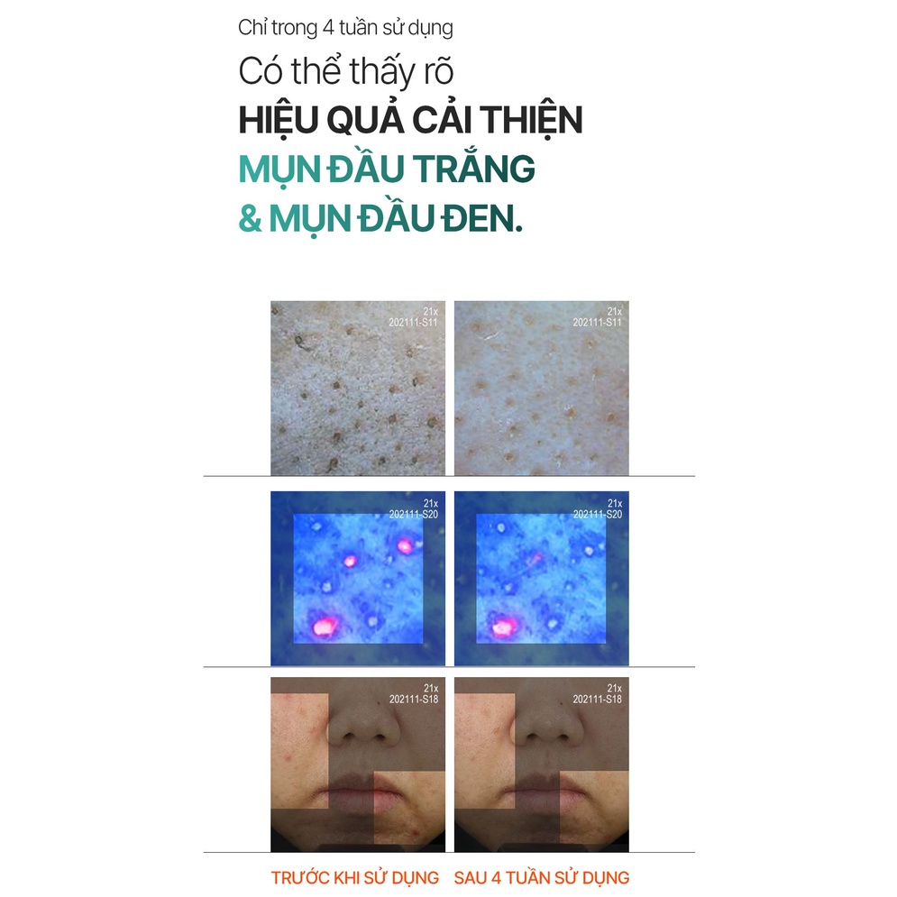 Sữa rửa mặt P.Calm UnderPore Foam Cleanser 150ml sạch sâu cho da