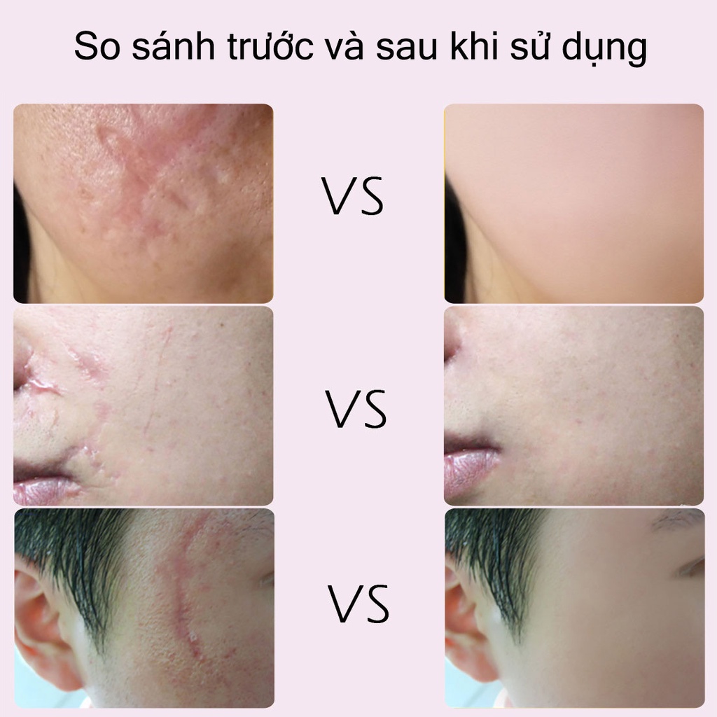 【💯Hàng thật】Kem xóa sẹo RtopR mango scar repair cream 15g Xóa và sửa sẹo trên mặt，cơ thể, vết bỏng ở trẻ em,  phụ nữ sau sinh mổ