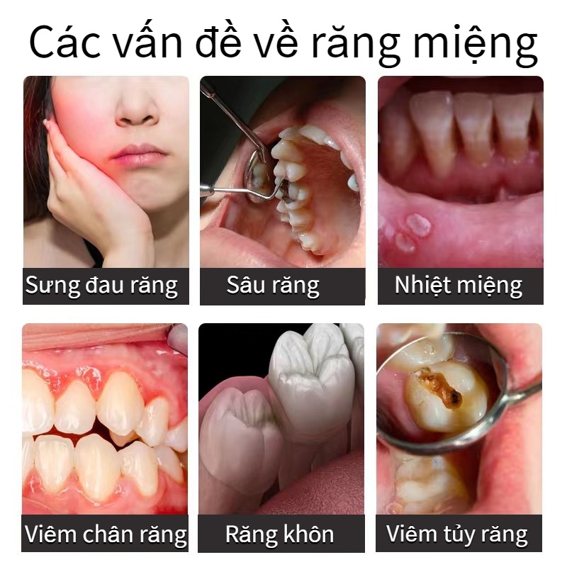 Xịt đau răng Chai Xịt Giảm Đau Răng Ê Buốt Giảm Đau Nhức Nhanh Chóng Ngăn Ngừa Sâu Răng Và Làm Thơm Miệng 30ml