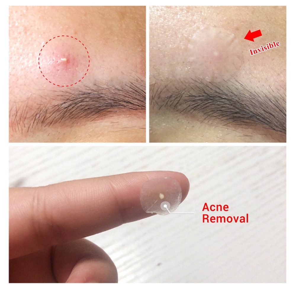Miếng dán mụn Labena Acne Pimple Patch nội địa Trung