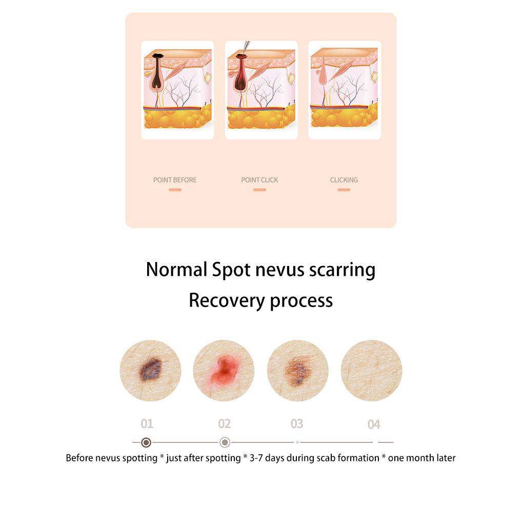 Bút Đèn LED Plasmas 9 Cấp Độ Loại Bỏ Đốm Xanh Dương Chăm Sóc Da