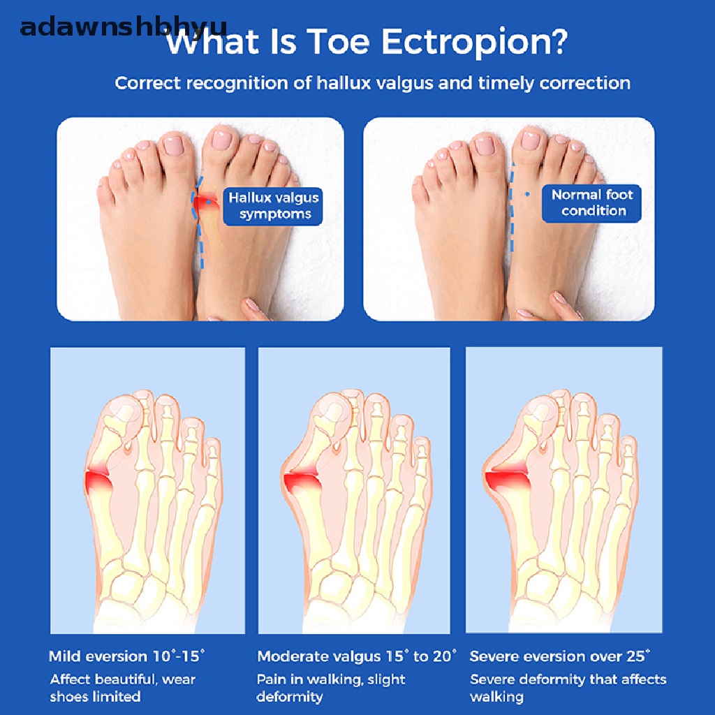 1 Cặp Silicon Tách Ngón Chân Cái Bảo Vệ Hiệu Quả