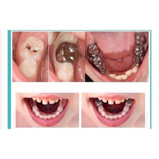 THÉP CHỤP BỌC RĂNG TRẺ EM