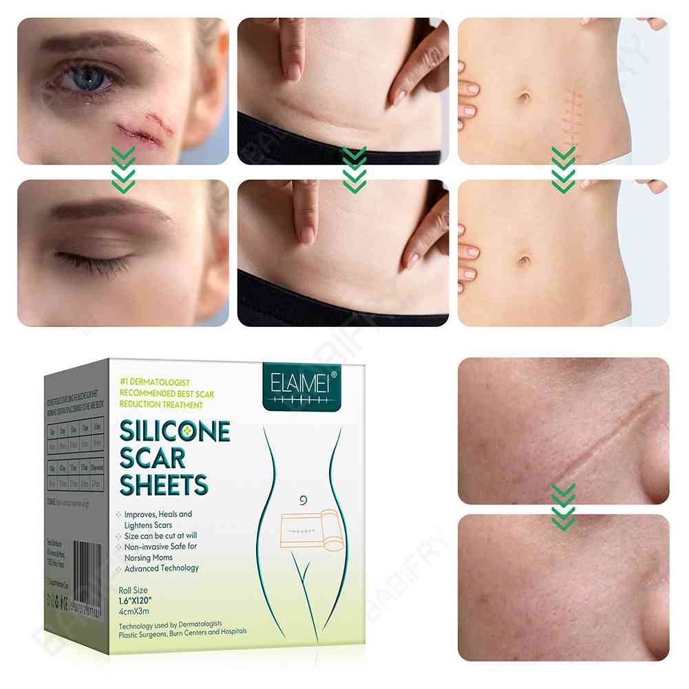 Cuộn Băng Keo Silicone 3M Loại Bỏ Sẹo Hiệu Quả