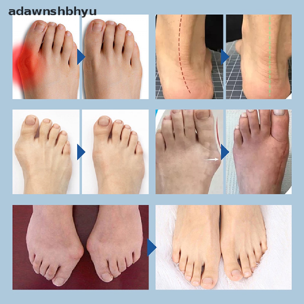 1 Cặp Silicon Tách Ngón Chân Cái Bảo Vệ Hiệu Quả