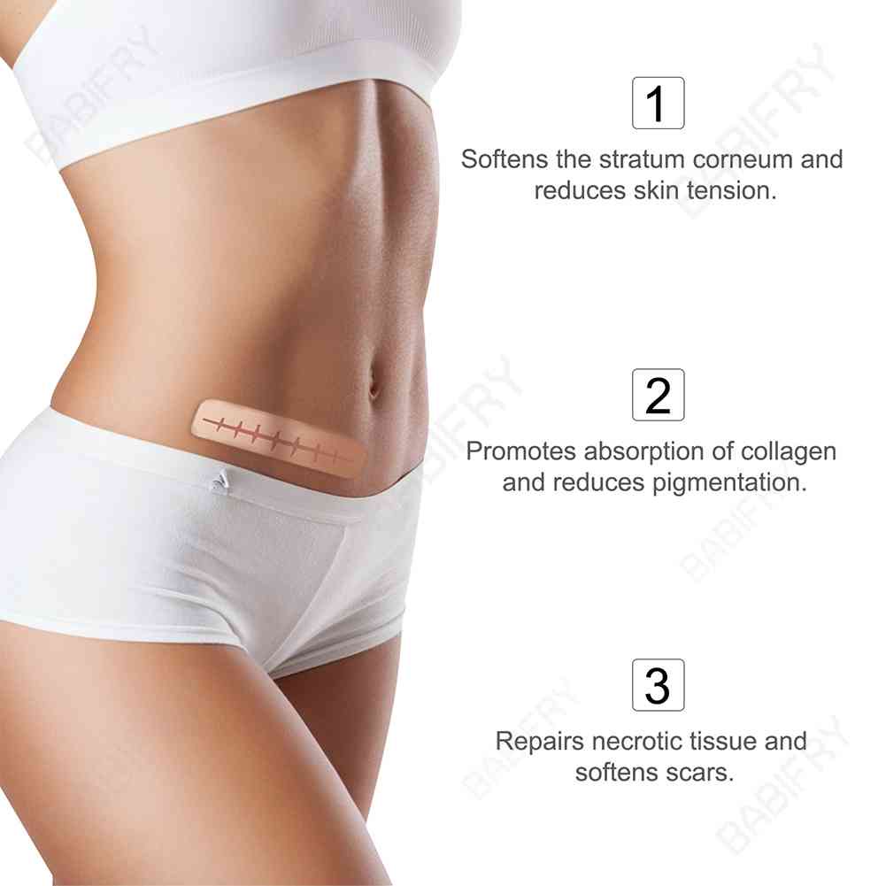 Cuộn Băng Keo Silicone 3M Loại Bỏ Sẹo Hiệu Quả