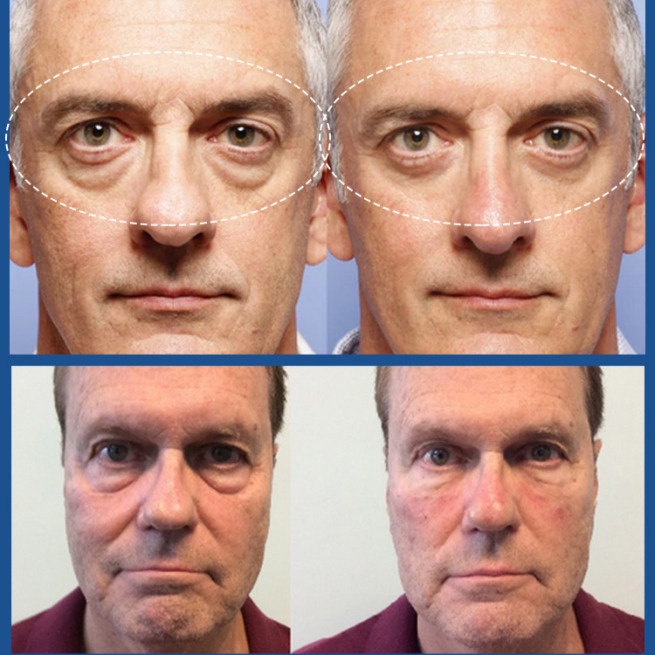 Kem Dưỡng Da Mắt Chống Lão Hóa Xóa Mờ Quầng Thâm / Bọng Mắt Làm Săn Chắc Da Cho Nam