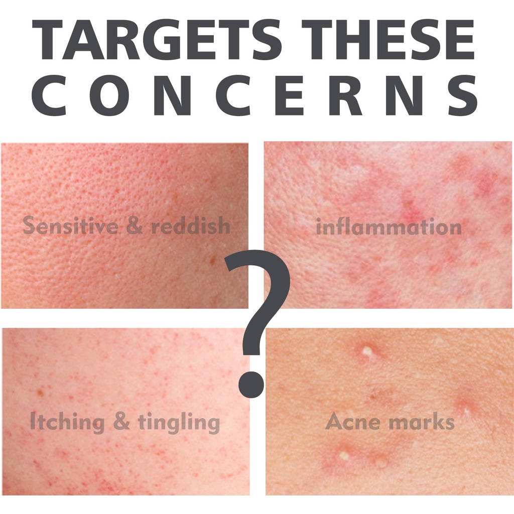 Serum Axit Salicylic 2% Tẩy Tế Bào Chết Hỗ trợ giảm mụn OUHOE