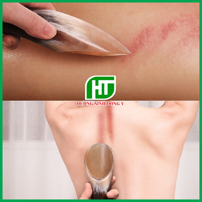 Dụng Cụ Cạo Gió Sừng Trâu, Đánh Gió Sừng Trâu