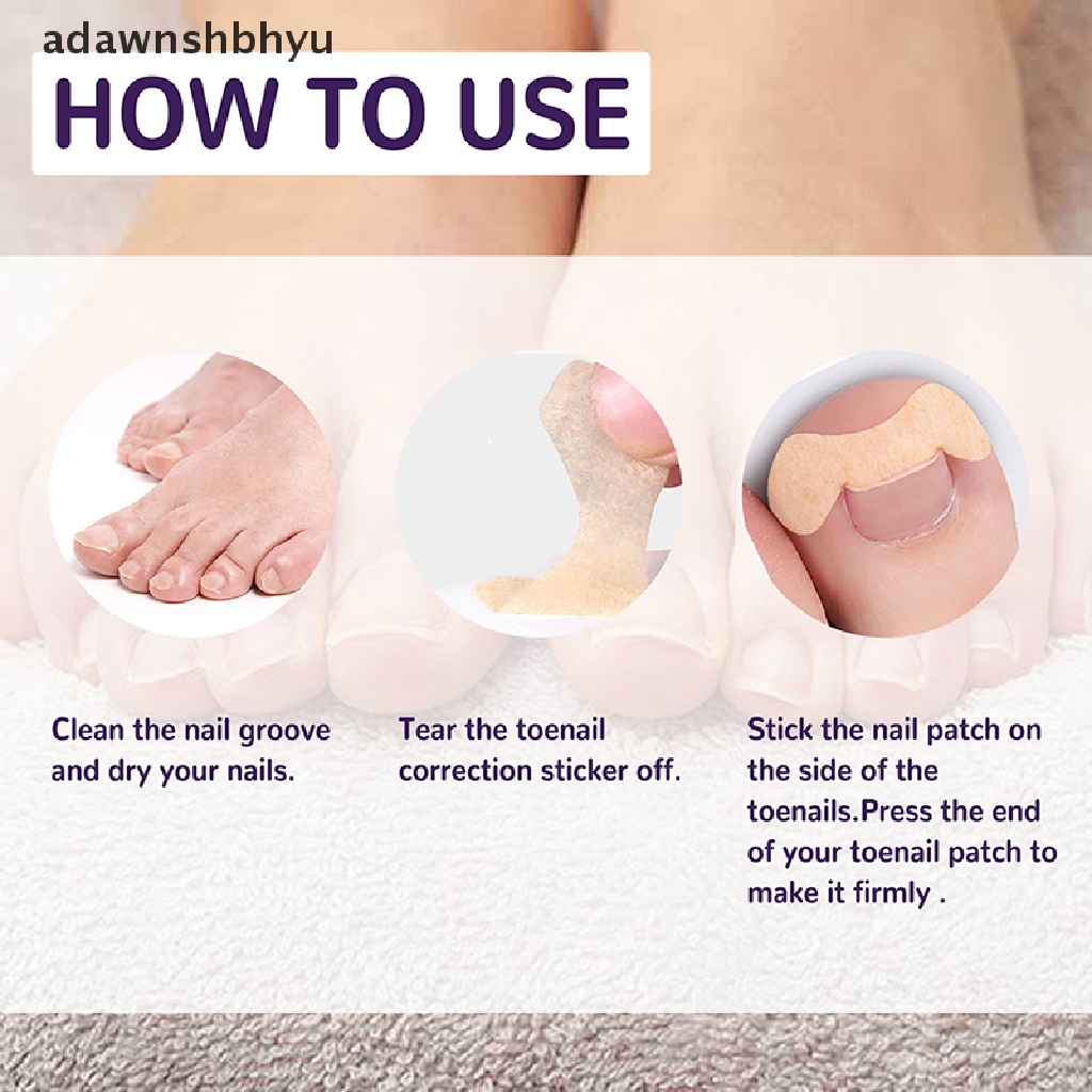 Set 50 Miếng Dán Chỉnh Sửa Móng Chân Mọc Ngược Tiện Dụng