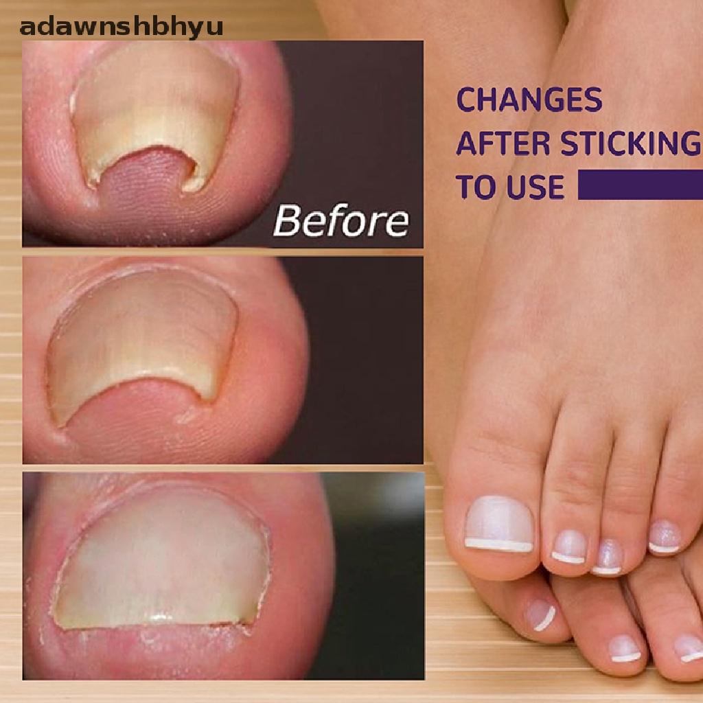 Set 50 Miếng Dán Chỉnh Sửa Móng Chân Mọc Ngược Tiện Dụng