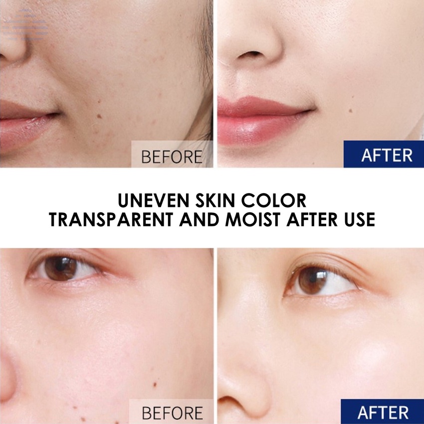 Whitening Freckle Facial Serum Dark Spot Corrector Powerful Removing Melasma Melanin Dark Spots Pigmentation Brightening Moisturizing Hydrating Face Essence Skin Care 30ml