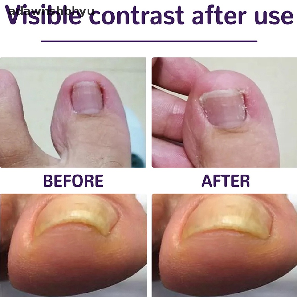 Set 50 Miếng Dán Chỉnh Sửa Móng Chân Mọc Ngược Tiện Dụng