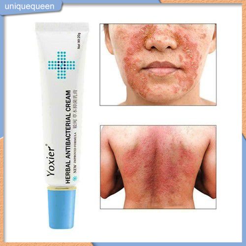 Kem Kháng Khuẩn Thảo Dược Yoxier 20G Kem Trị Vảy Nến Giảm Ngứa Eczema Điều Trị Bong Vảy Phát Ban Da Uni