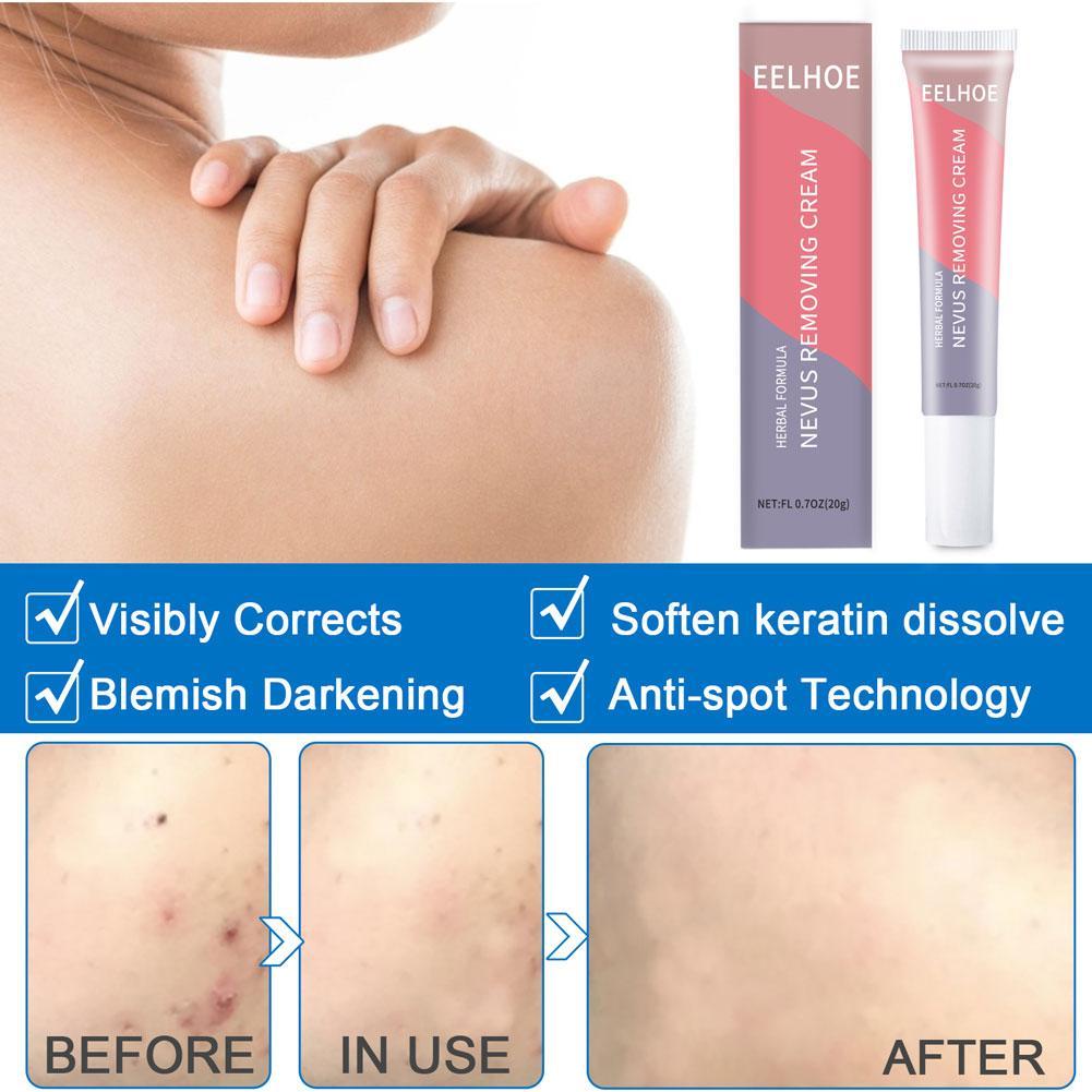 Kem Hỗ trợ giảm sẹo Mụn Phục Hồi Da Hiệu Quả 20g