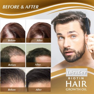 Tinh Chất Kích Thích Mọc Tóc Chống Rụng Tóc Hiệu Quả