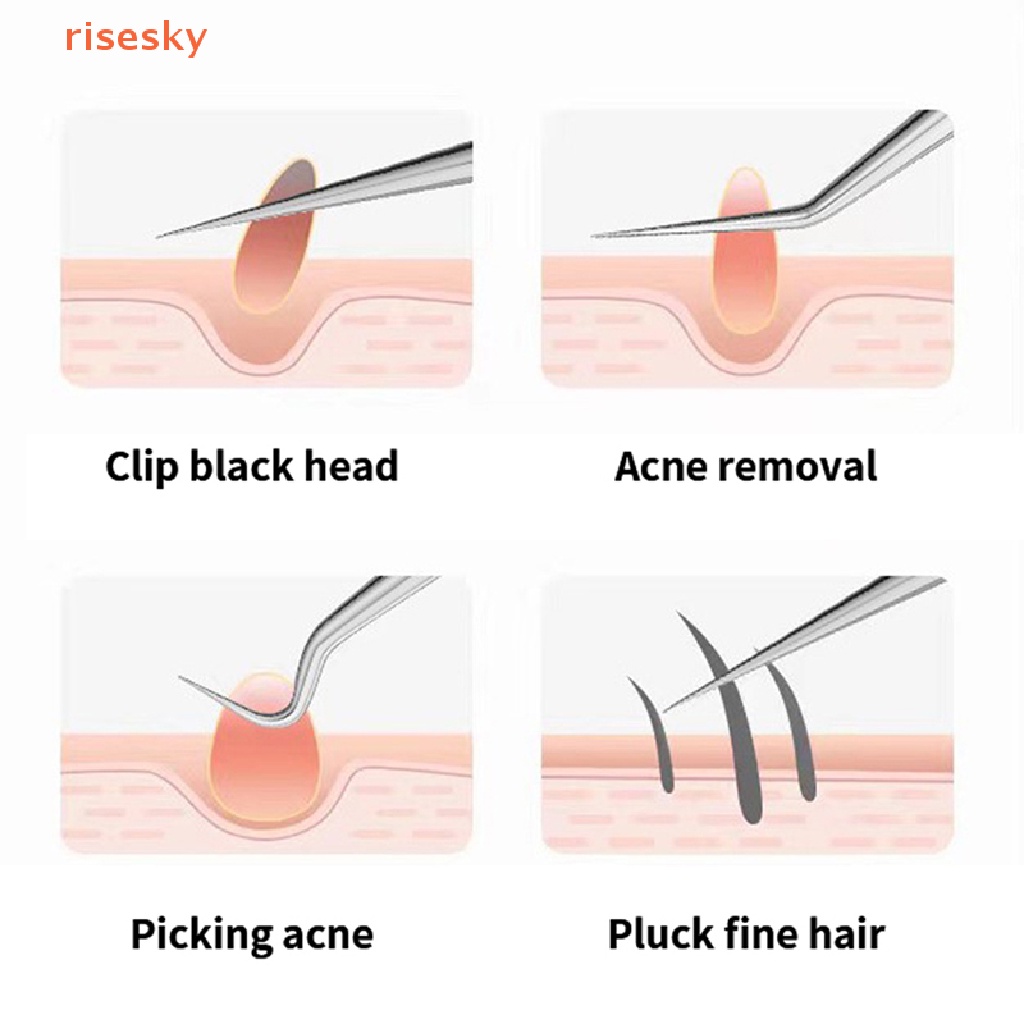Nhíp Đầu Nhọn Loại Bỏ Mụn Đầu Đen / Mụn Trứng Cá Tiện Dụng