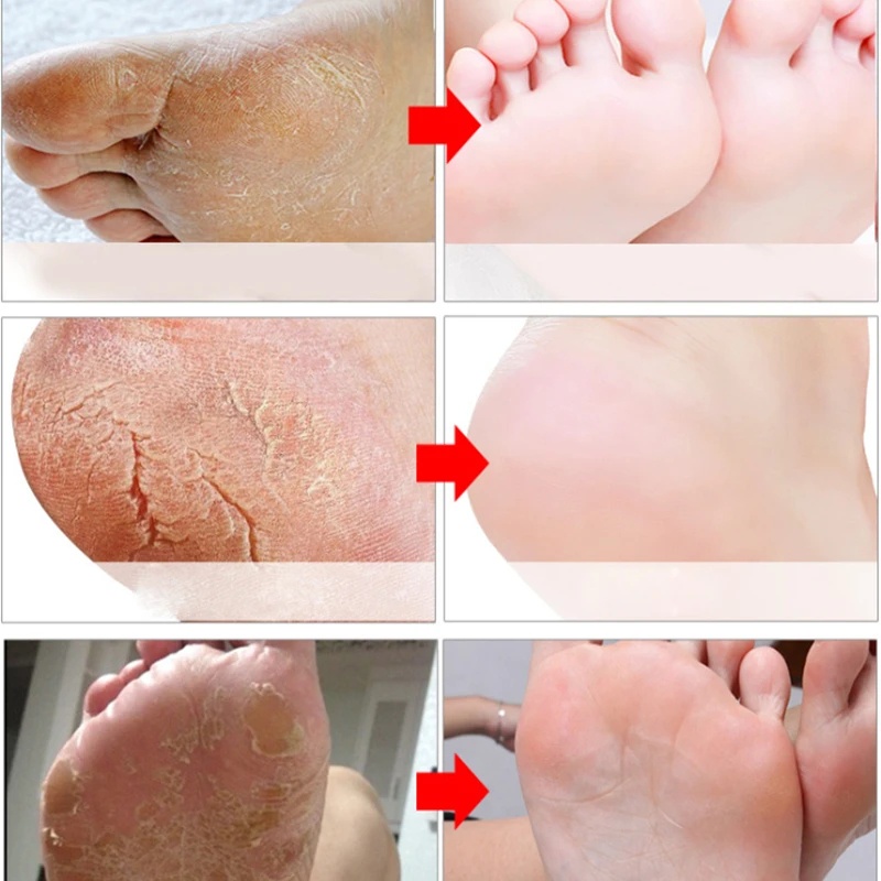 Mặt Nạ Chân Giúp Tẩy Tế Bào Chết Và Dưỡng Ẩm Cho Da Chân