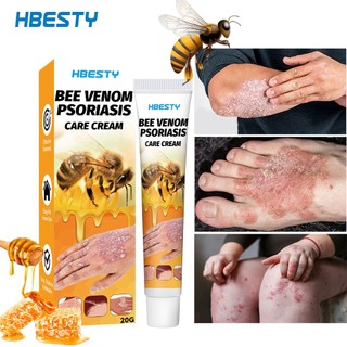Kem điều trị bệnh vẩy nến bee venom, kem điều trị bệnh vẩy nến youth bee venom, kem điều trị bệnh vẩy nến bee new zealand, kem Hỗ trợ giảm vẩy nến làm dịu và dưỡng ẩm