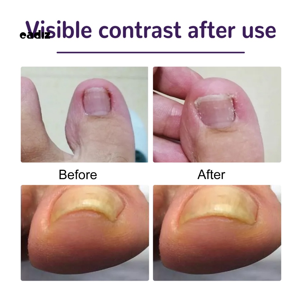 Bộ 50 Miếng Dán Móng Chân Thoáng Khí Hình Bướm Cho Nam