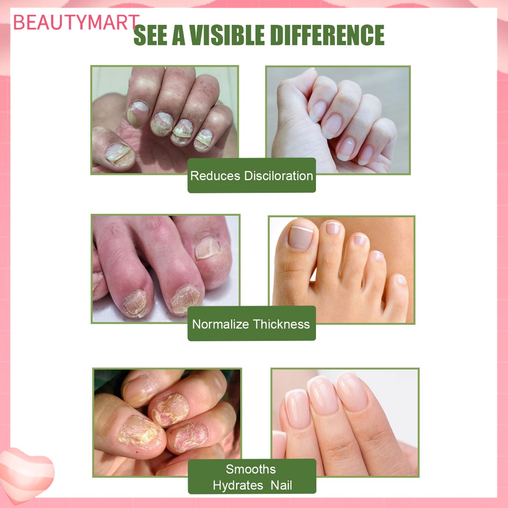 Tinh Chất Hỗ Trợ Giảm Nấm Móng Chống Nhiễm Trùng Hiệu Quả 10ml