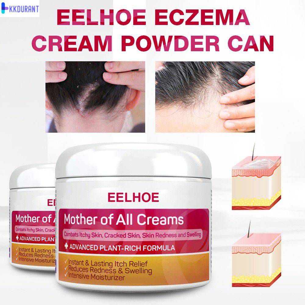 Eelhoe Da Kem Vảy Nến Viêm Da Eczematoid Chàm Thuốc Mỡ Điều Trị Vảy Nến Kem Chăm Sóc Da Chống Ngứa KKDURANT