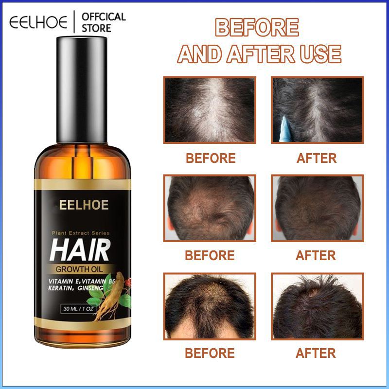 ⚡⚡Thanh Toán Khi Nhận Hàng EELHOE Serum Moroccan Mọc Tóc Chống Rụng Tóc Ngăn Ngừa Hói Đầu Điều Trị Sửa Chữa Da Đầu Khô Hư Tổn Đường Chân Tóc Tiết Bã Hướng Lên Trên Để Chăm Sóc Tóc Làm Đẹp