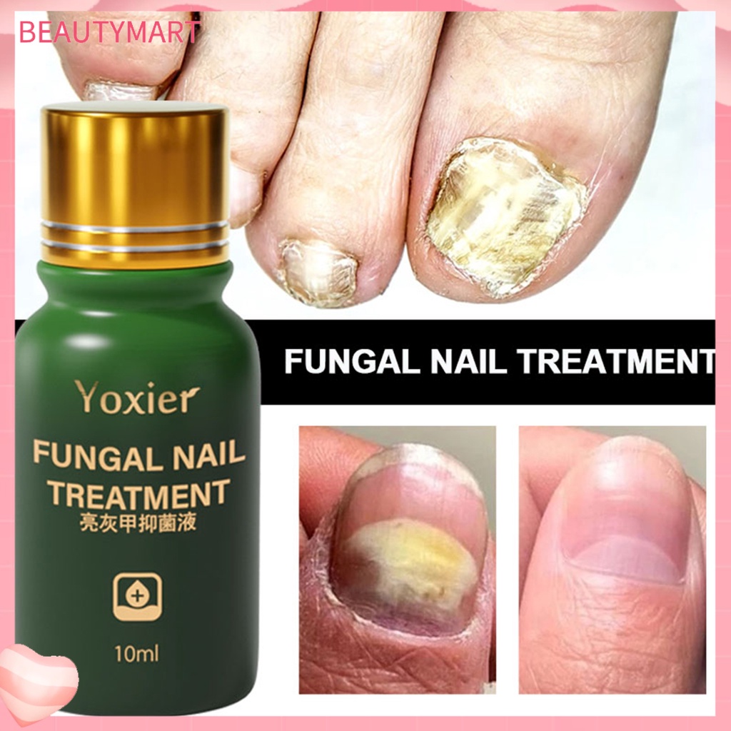 Tinh Chất Hỗ Trợ Giảm Nấm Móng Chống Nhiễm Trùng Hiệu Quả 10ml