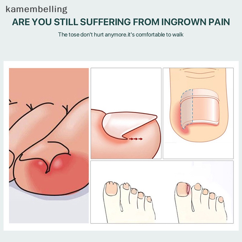 Kamembelling Dụng Cụ Định Hình Móng Chân Mọc Ngược