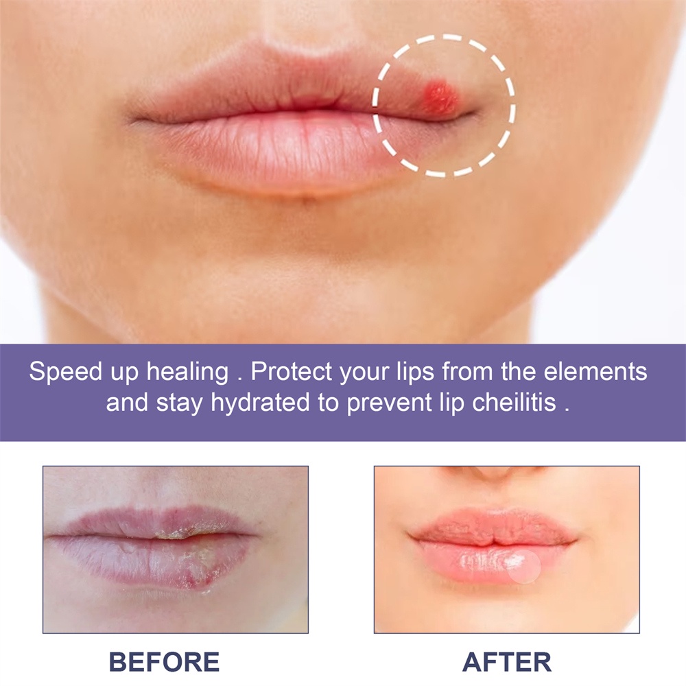 Eelhoe Cold Herpes Smoothing Patch Kháng khuẩn Chống viêm Sửa chữa Môi Chăm sóc Môi Sức khỏe Herpes Care Patch uni