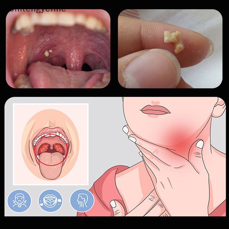 Ctye thép không gỉ tonsil stone remover tools led light mouth cleaner care tool fine