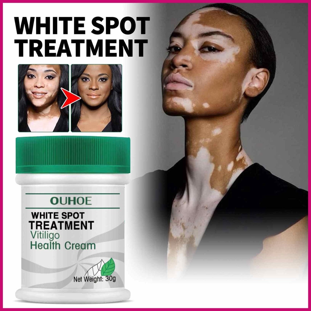 Kem Phục Hồi Da Vitiligo Làm Trắng Xóa Mờ Vết Thâm Và Chống Mồ Hôi